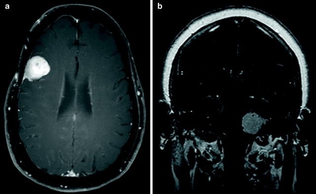 Meningioma